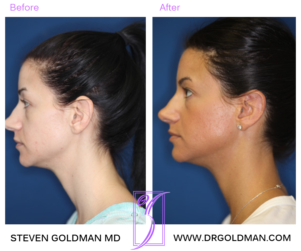 Otoplasty