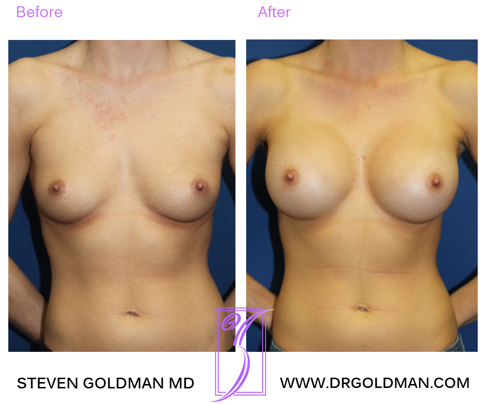 Breast Augmentation
