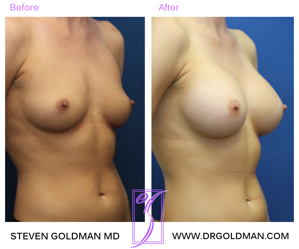 Breast Augmentation