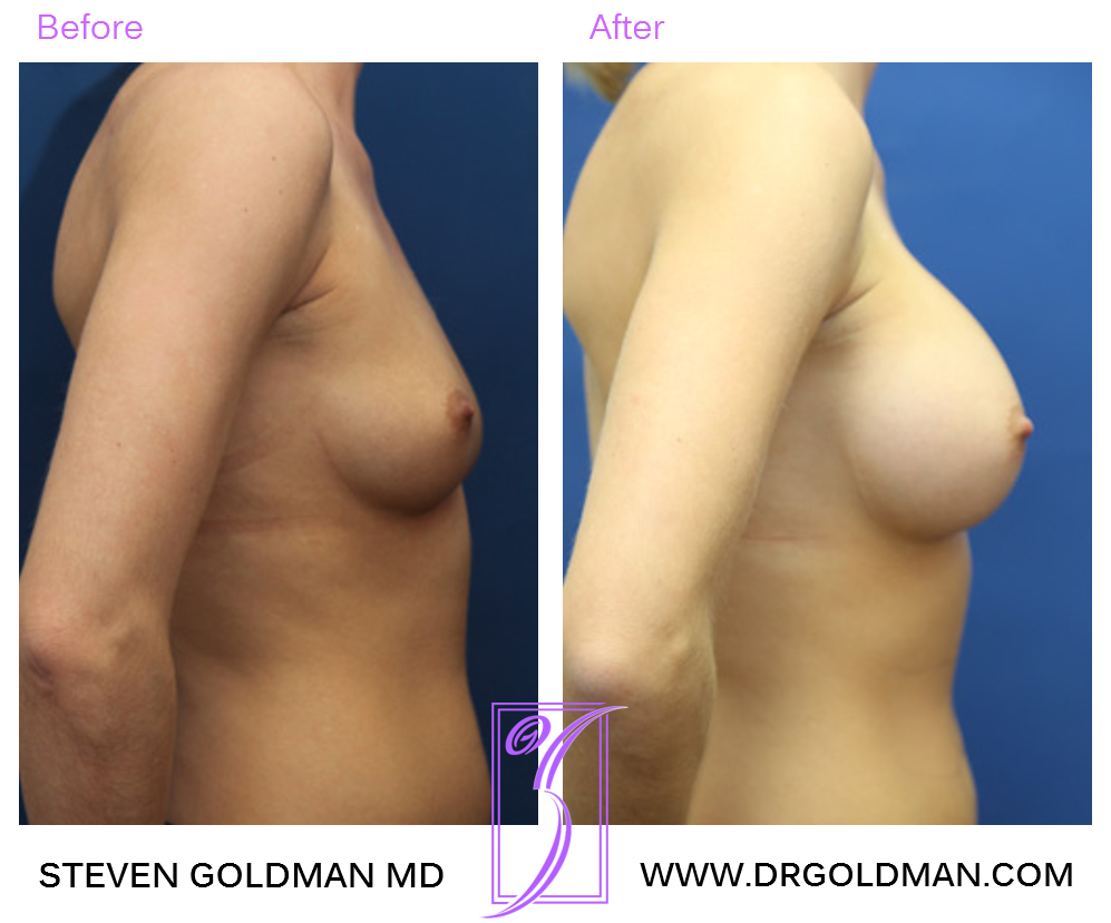 Breast Augmentation