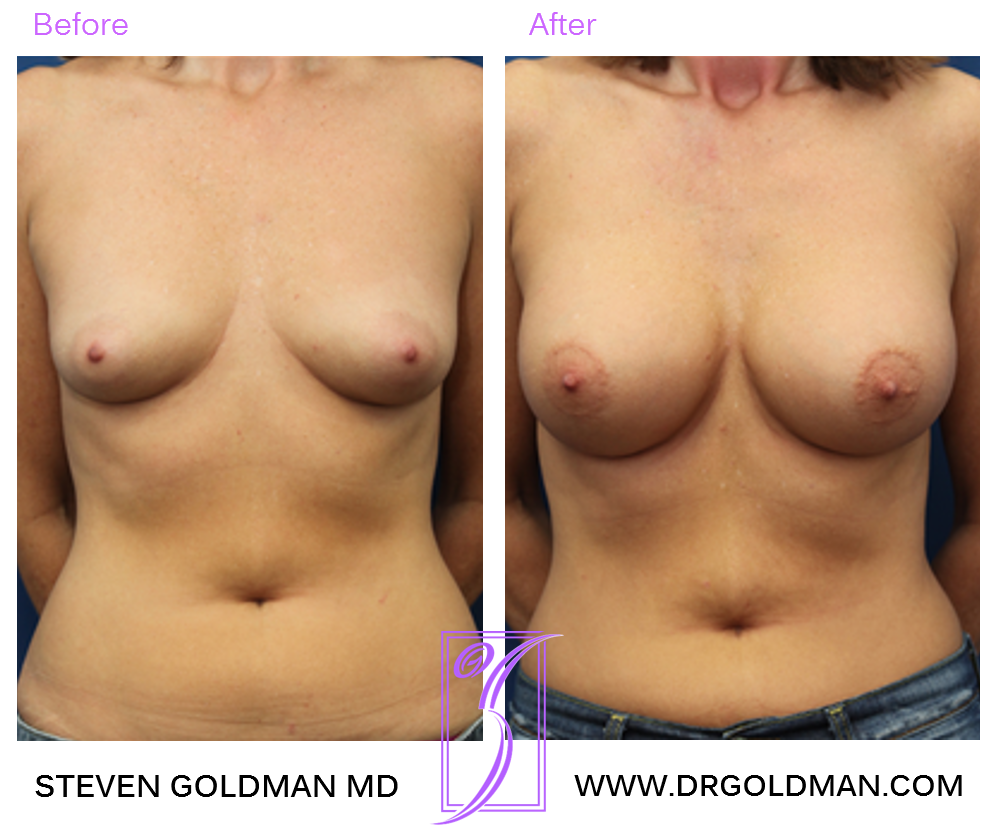 Breast Augmentation