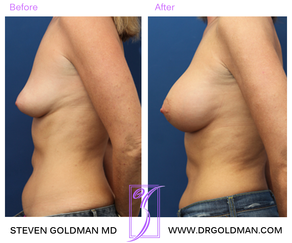 Breast Augmentation