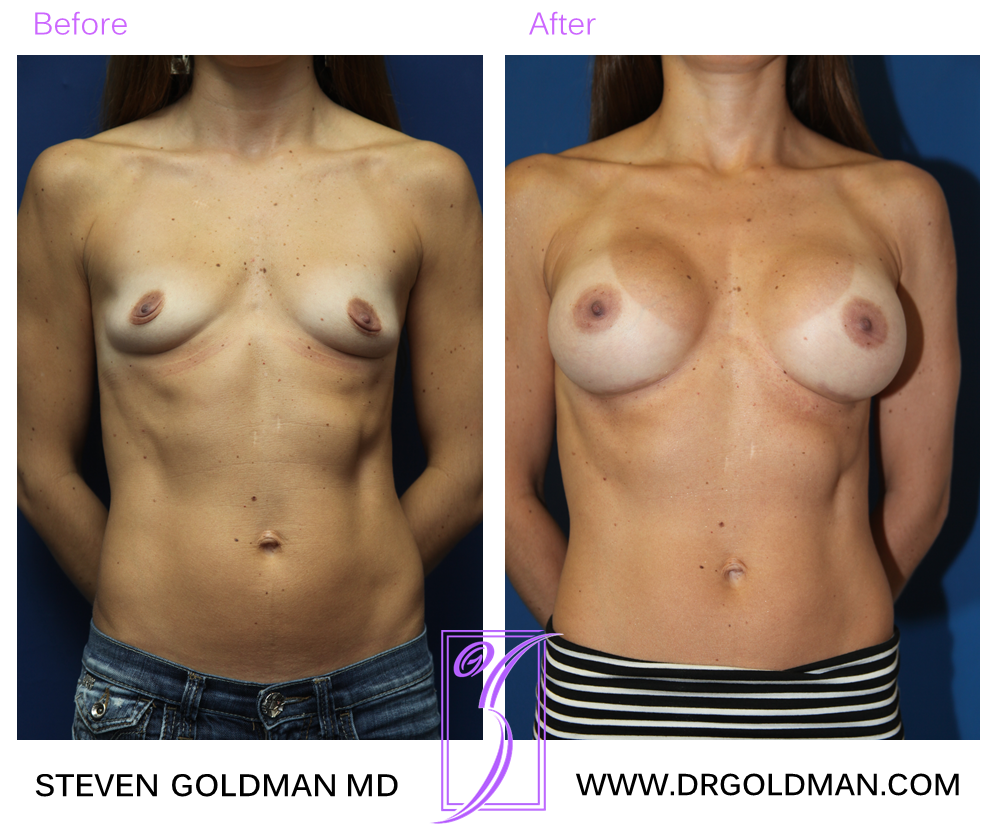 Breast Augmentation