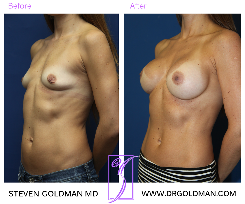 Breast Augmentation