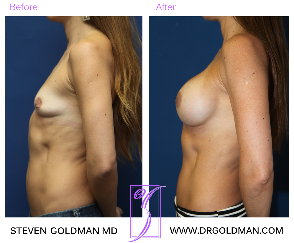 Breast Augmentation
