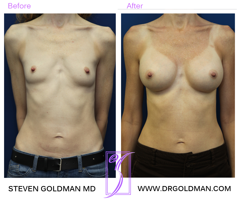 Breast Augmentation