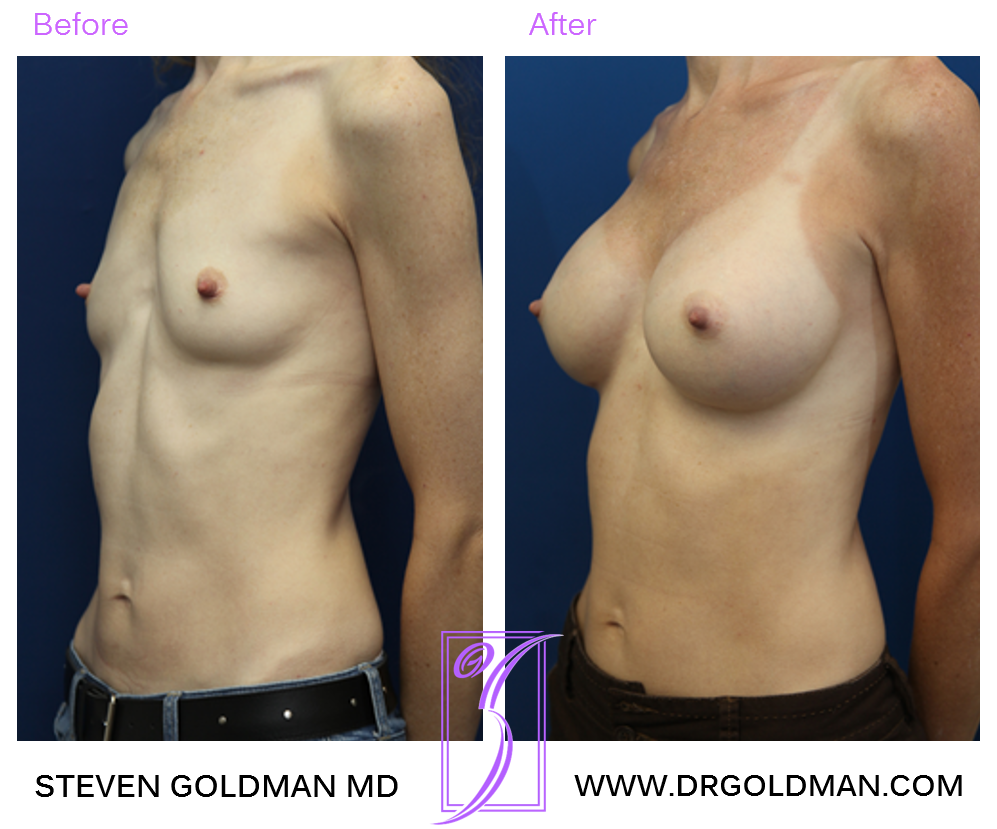 Breast Augmentation