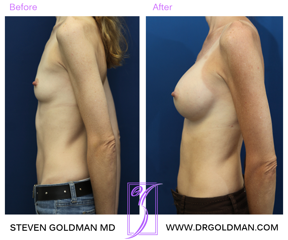 Breast Augmentation