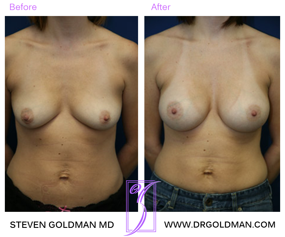 Breast Augmentation