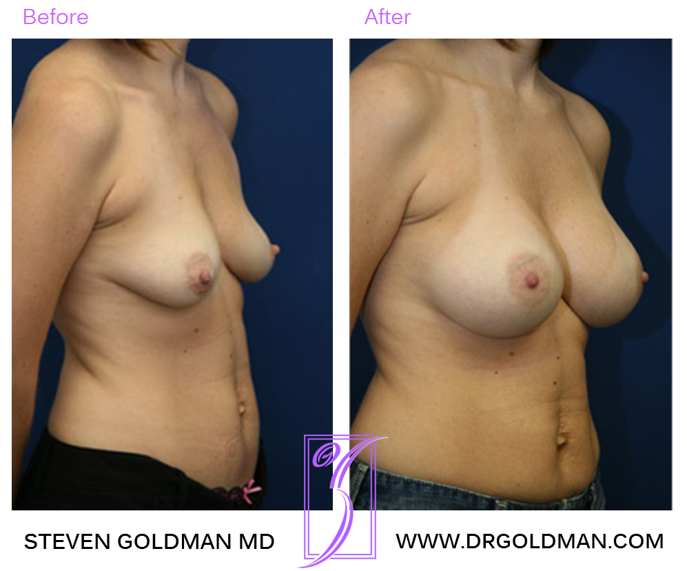 Breast Augmentation