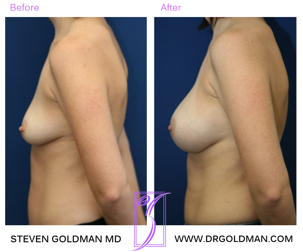 Breast Augmentation