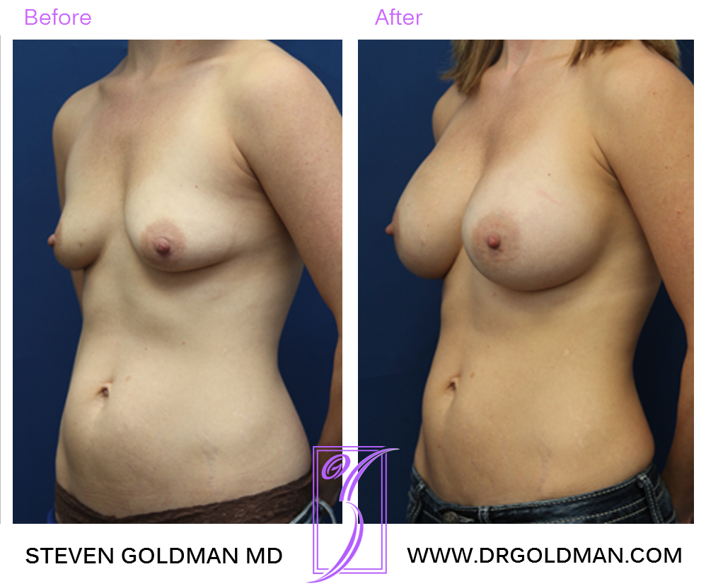 Breast Augmentation