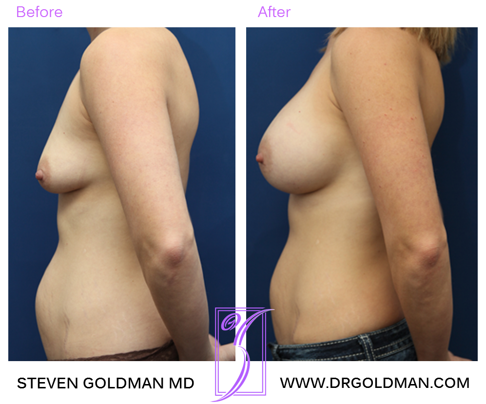Breast Augmentation