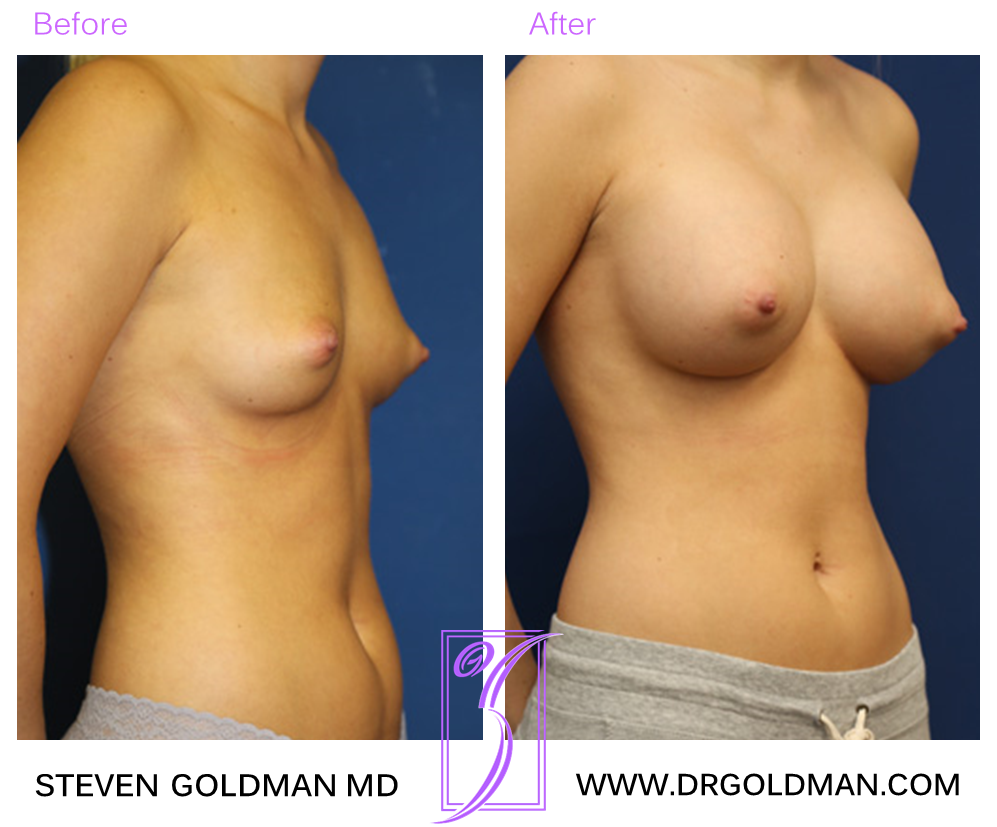 Breast Augmentation