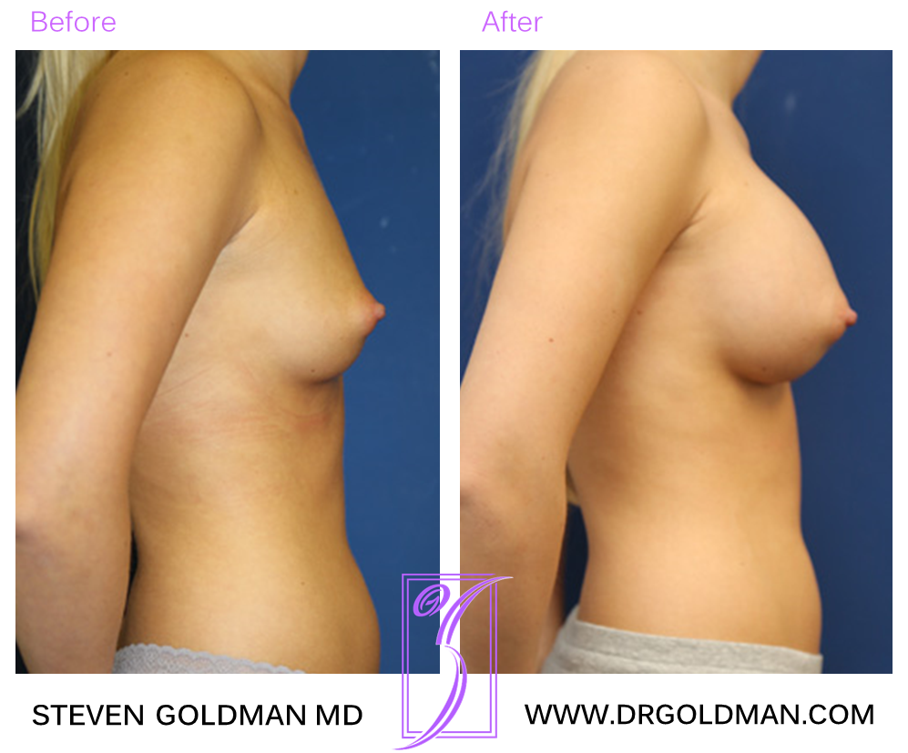 Breast Augmentation