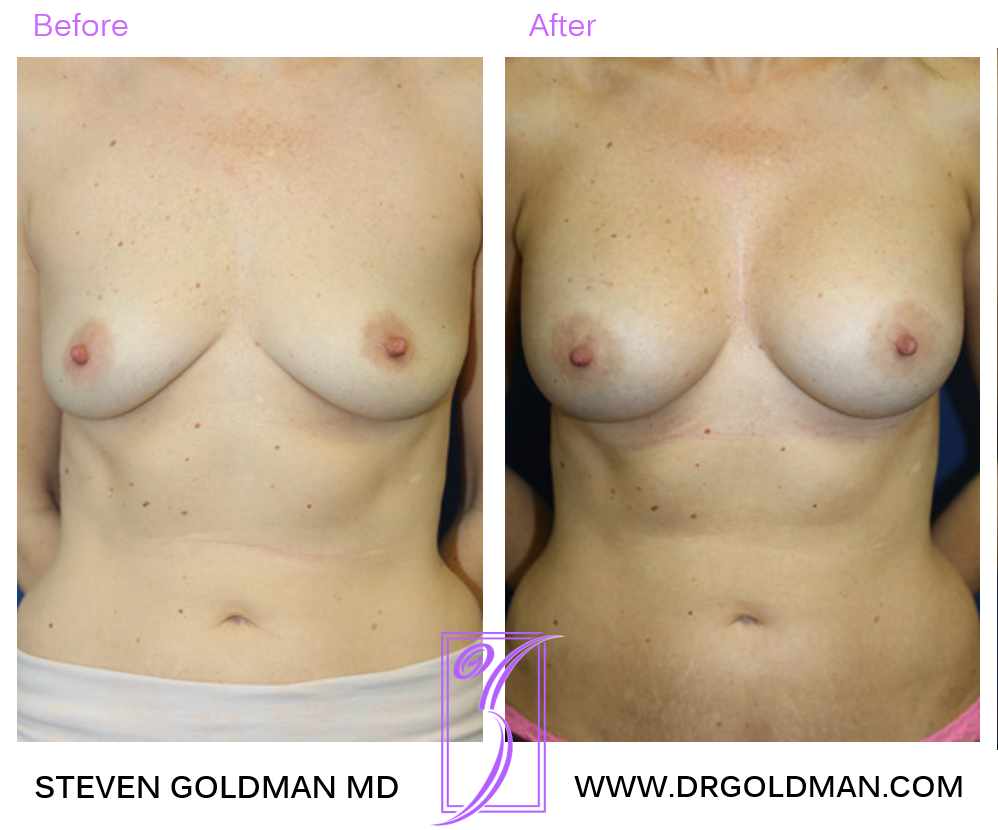 Breast Augmentation