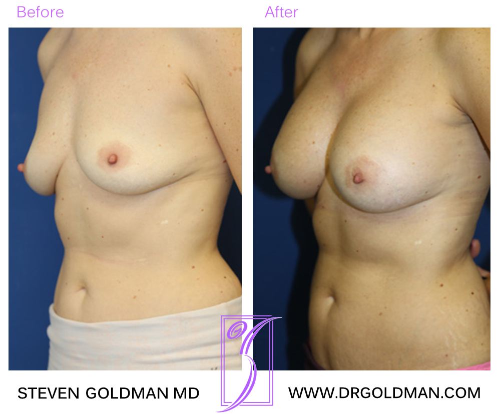Breast Augmentation