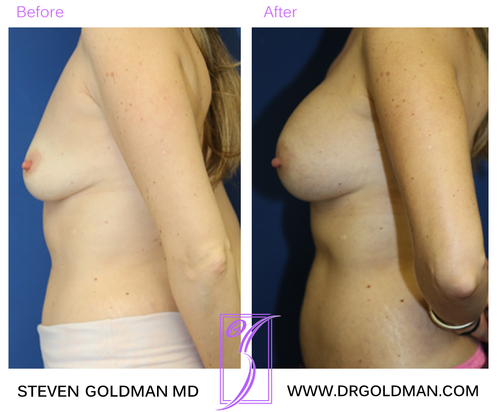Breast Augmentation