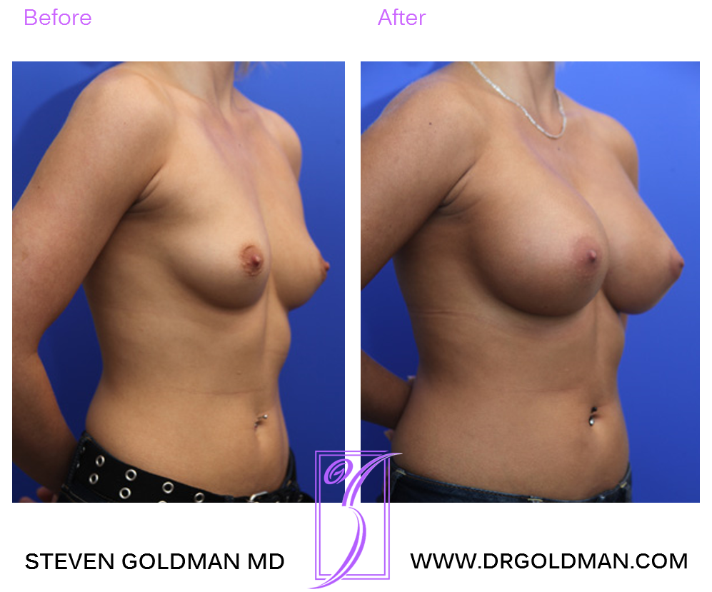 Breast Augmentation