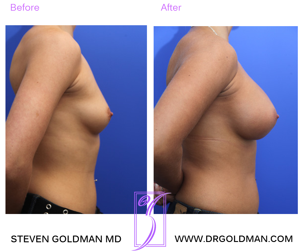 Breast Augmentation