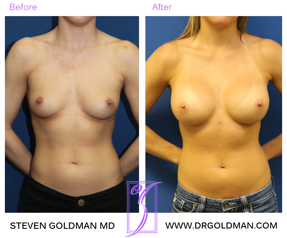 Breast Augmentation