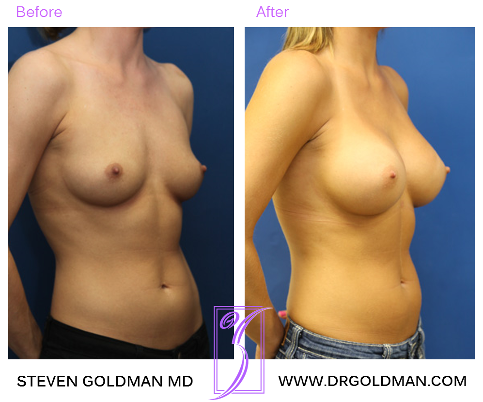 Breast Augmentation