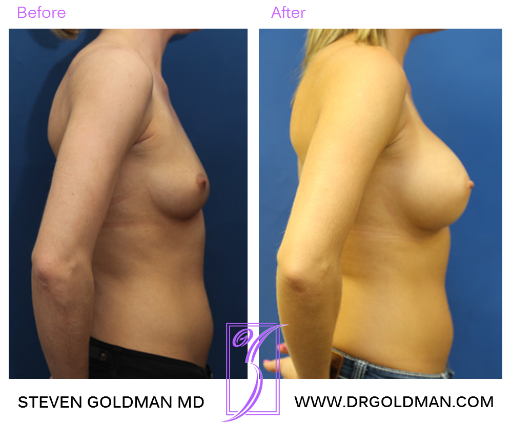 Breast Augmentation