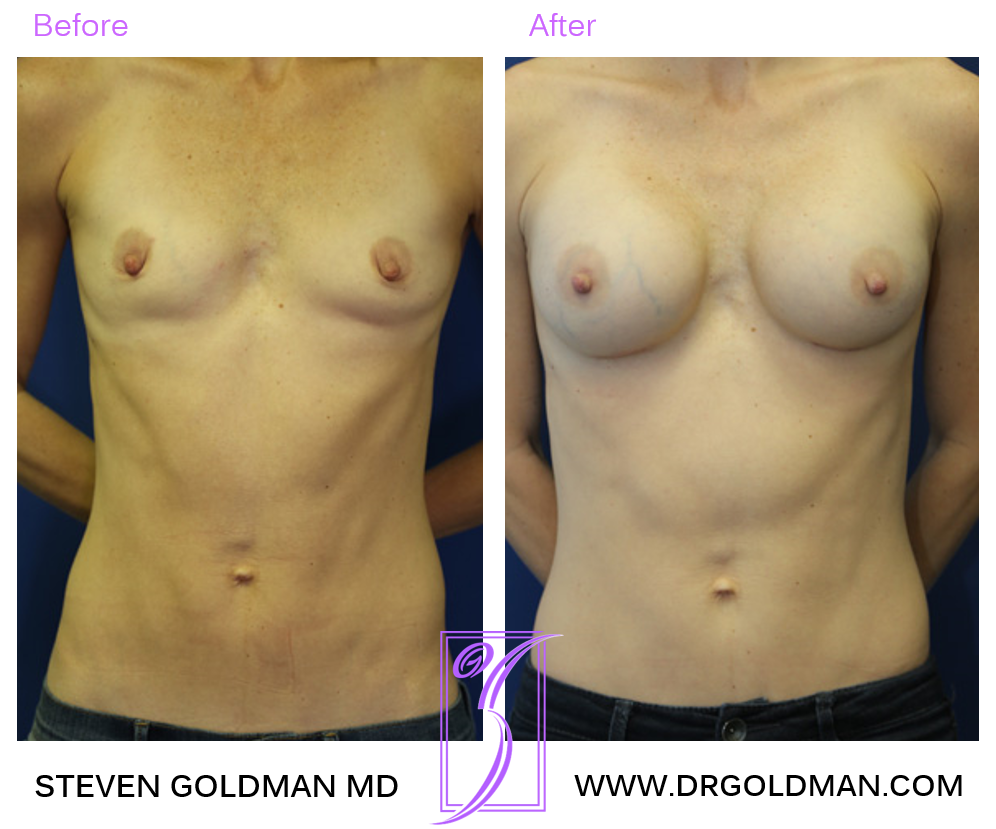 Breast Augmentation