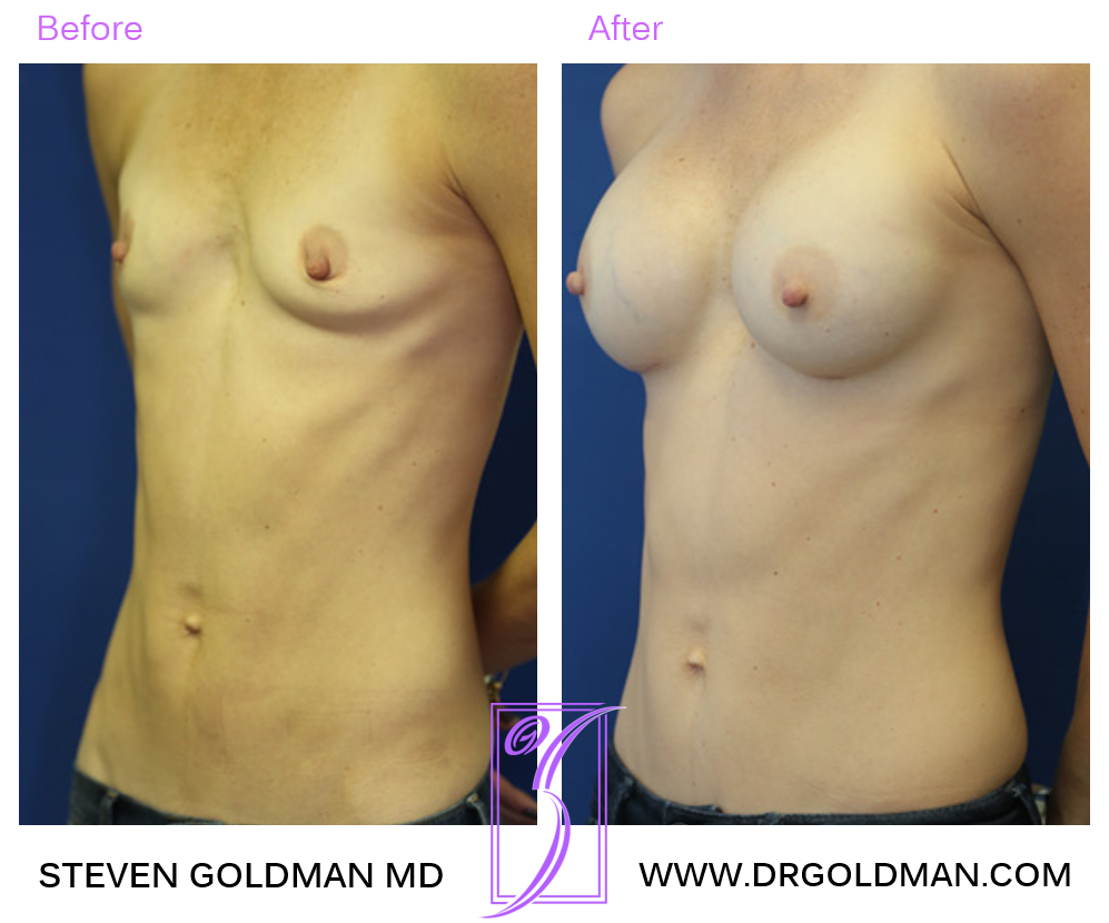 Breast Augmentation