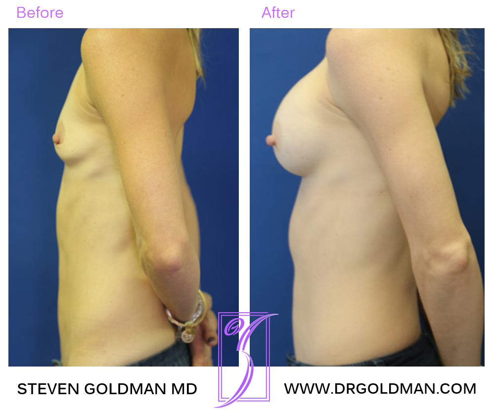 Breast Augmentation