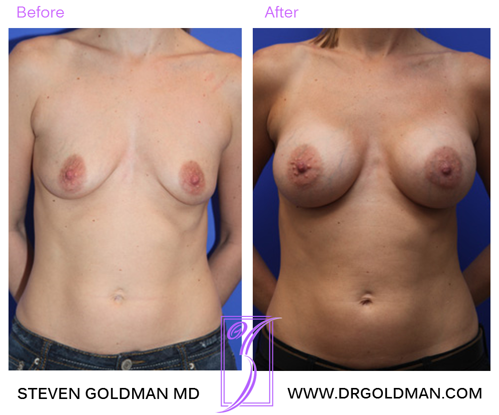 Breast Augmentation