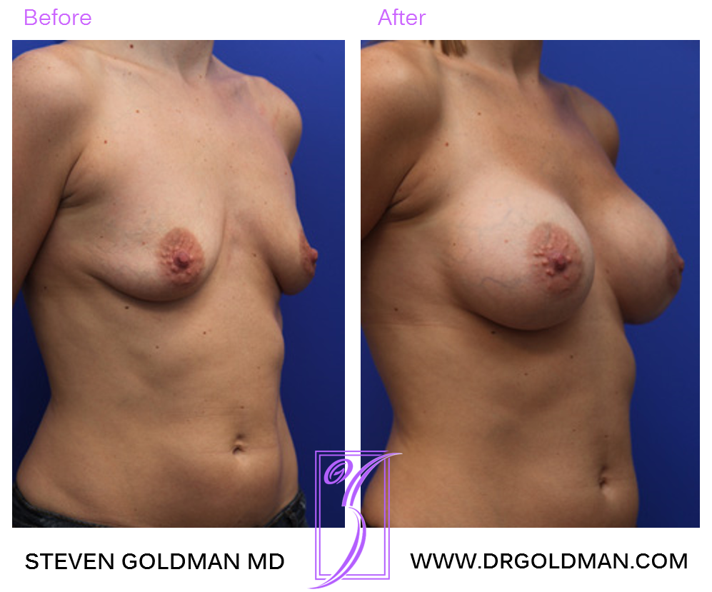 Breast Augmentation