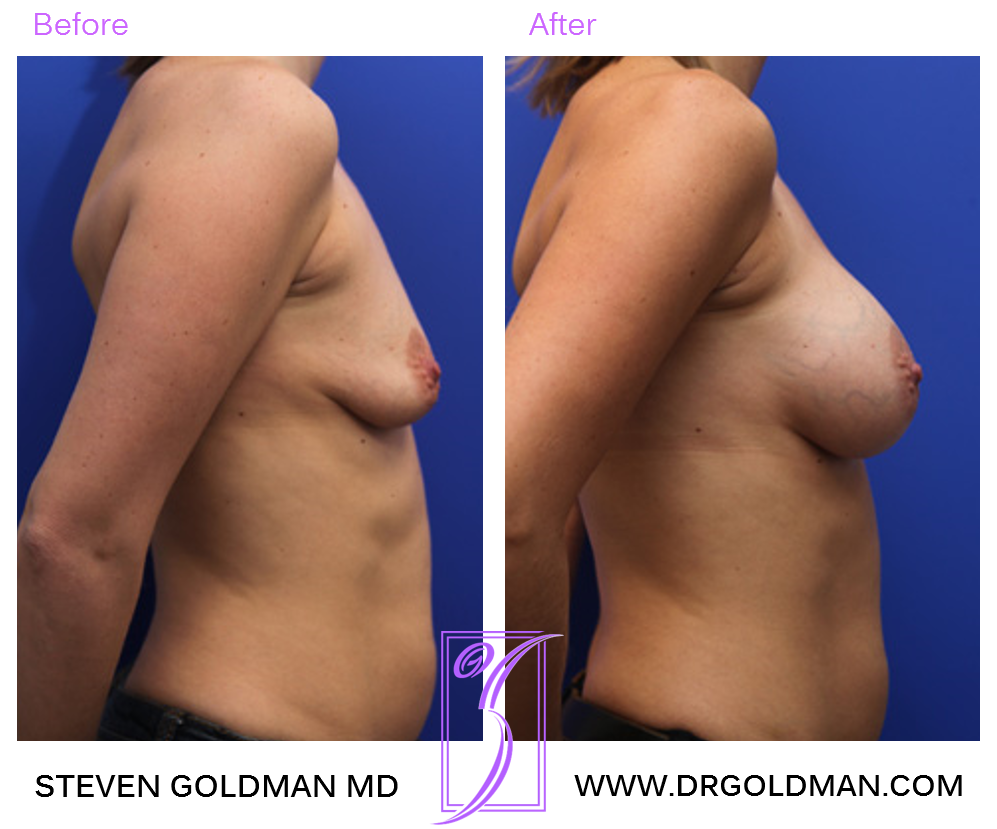 Breast Augmentation