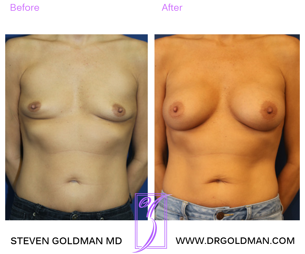 Breast Augmentation