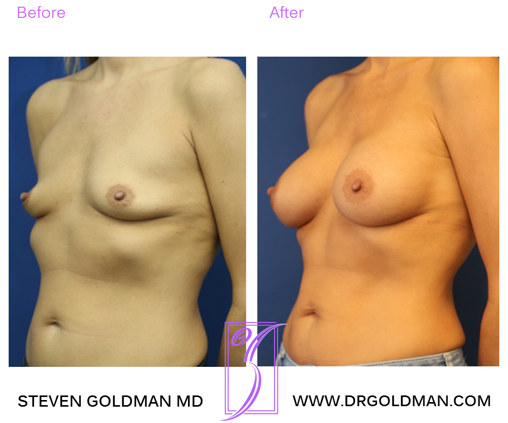 Breast Augmentation
