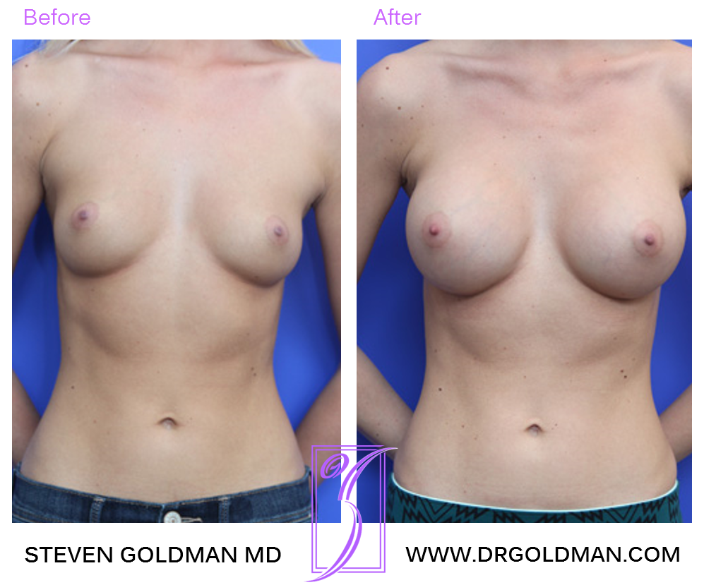 Breast Augmentation