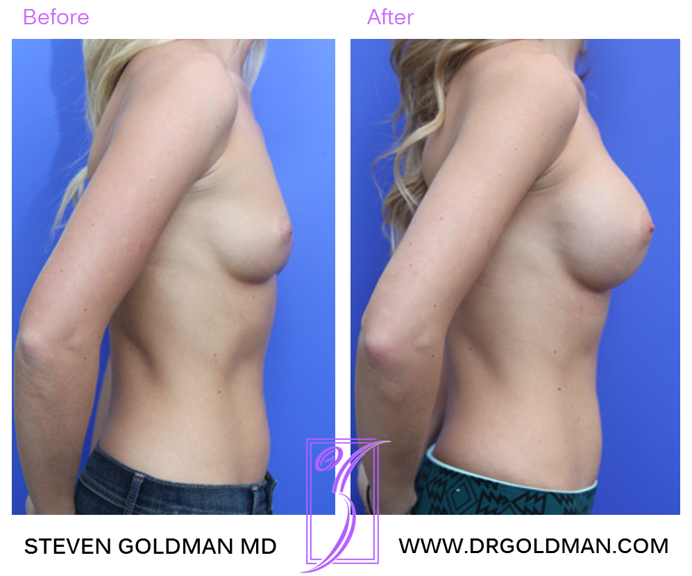 Breast Augmentation