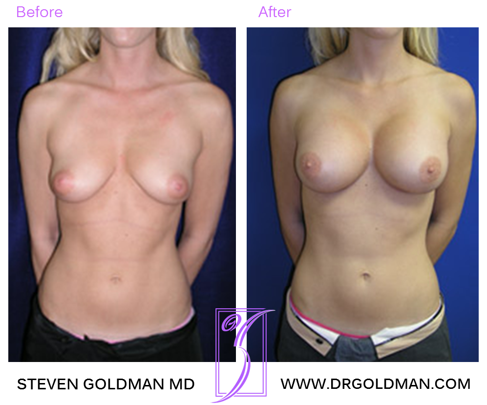 Breast Augmentation