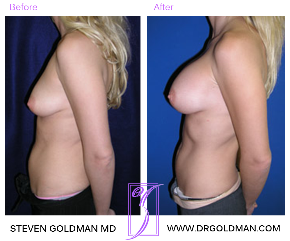 Breast Augmentation