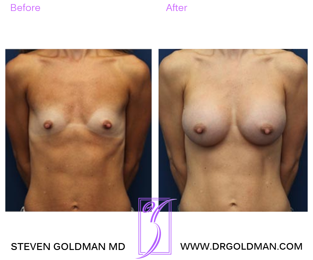 Breast Augmentation