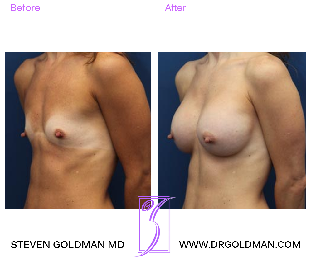 Breast Augmentation