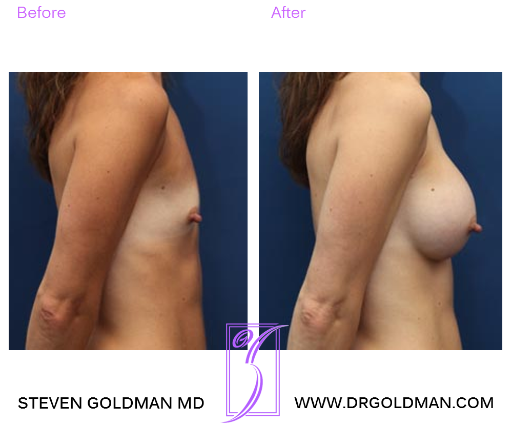 Breast Augmentation