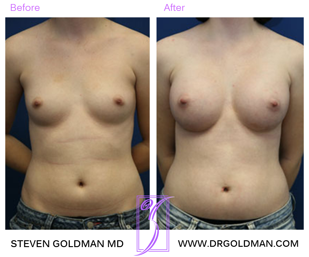 Breast Augmentation
