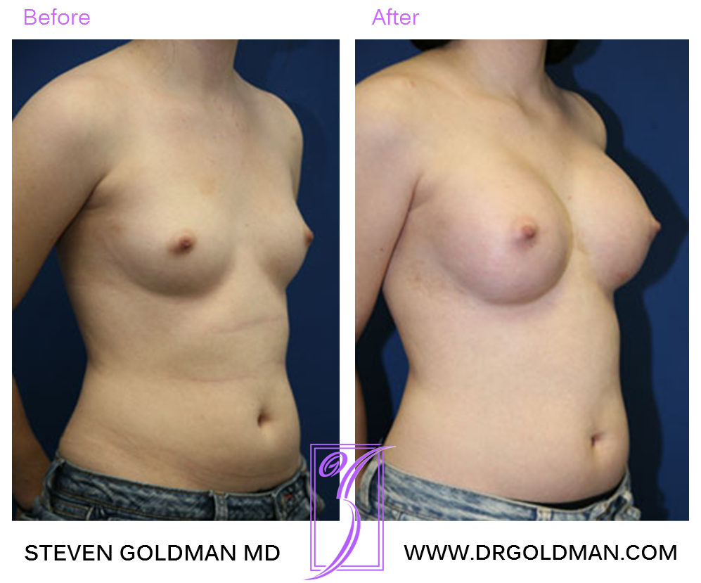 Breast Augmentation