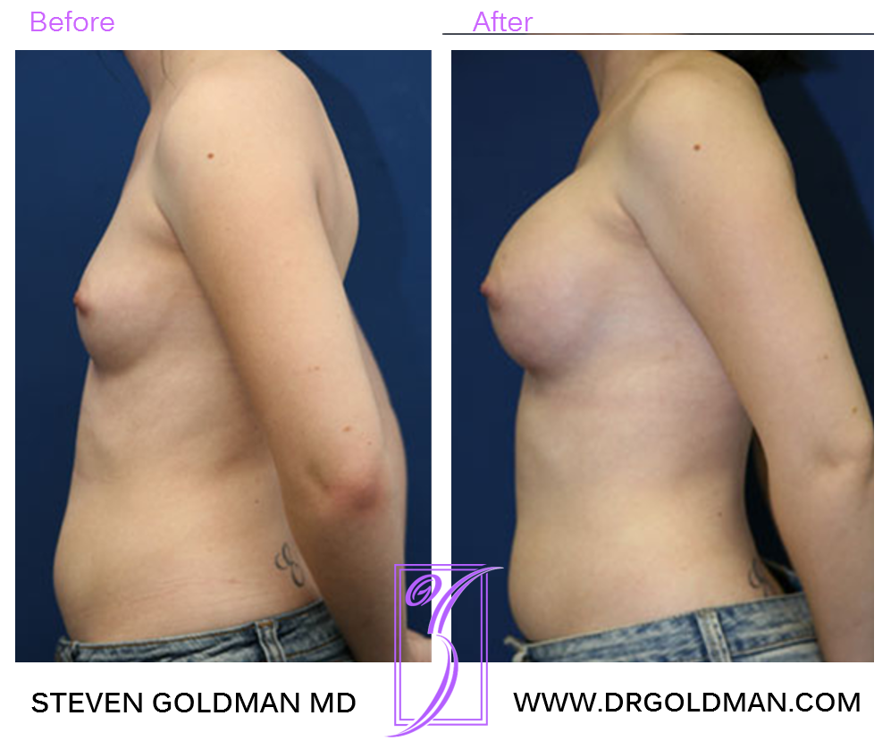 Breast Augmentation