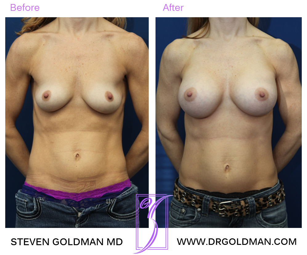 Breast Augmentation