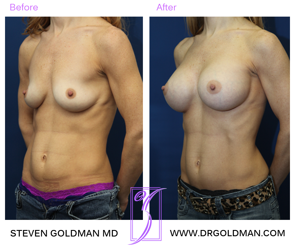 Breast Augmentation