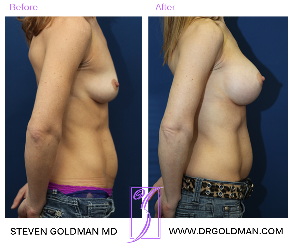 Breast Augmentation
