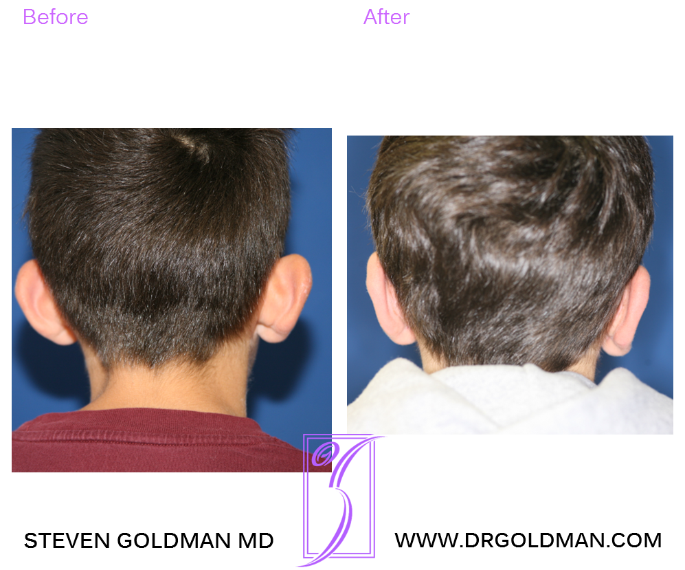 Otoplasty