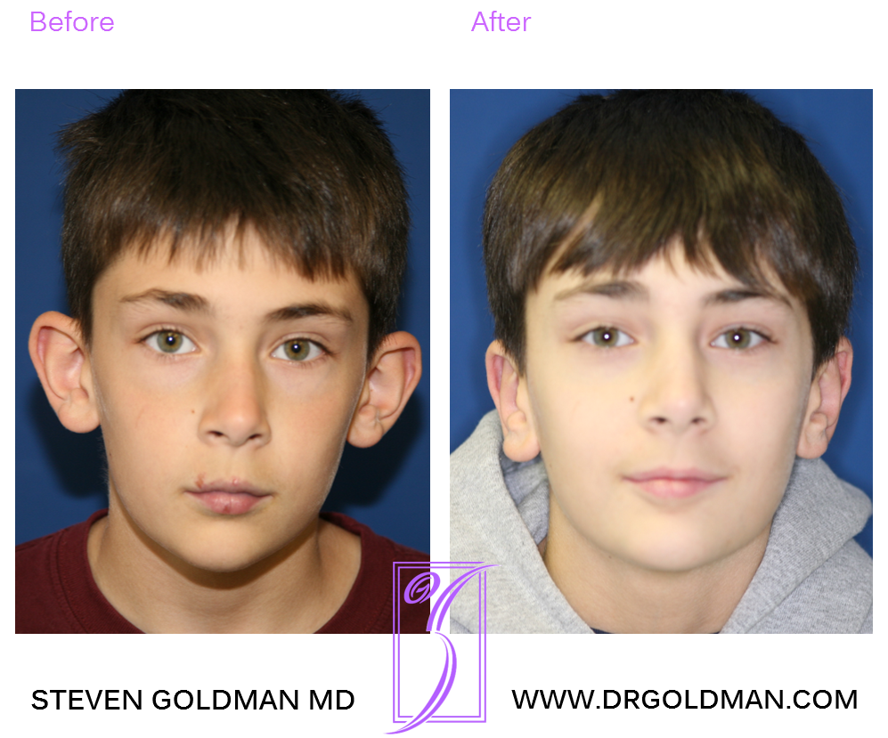 Otoplasty